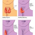 Удаление щитовидной железы без шрамов в клинике Ассута